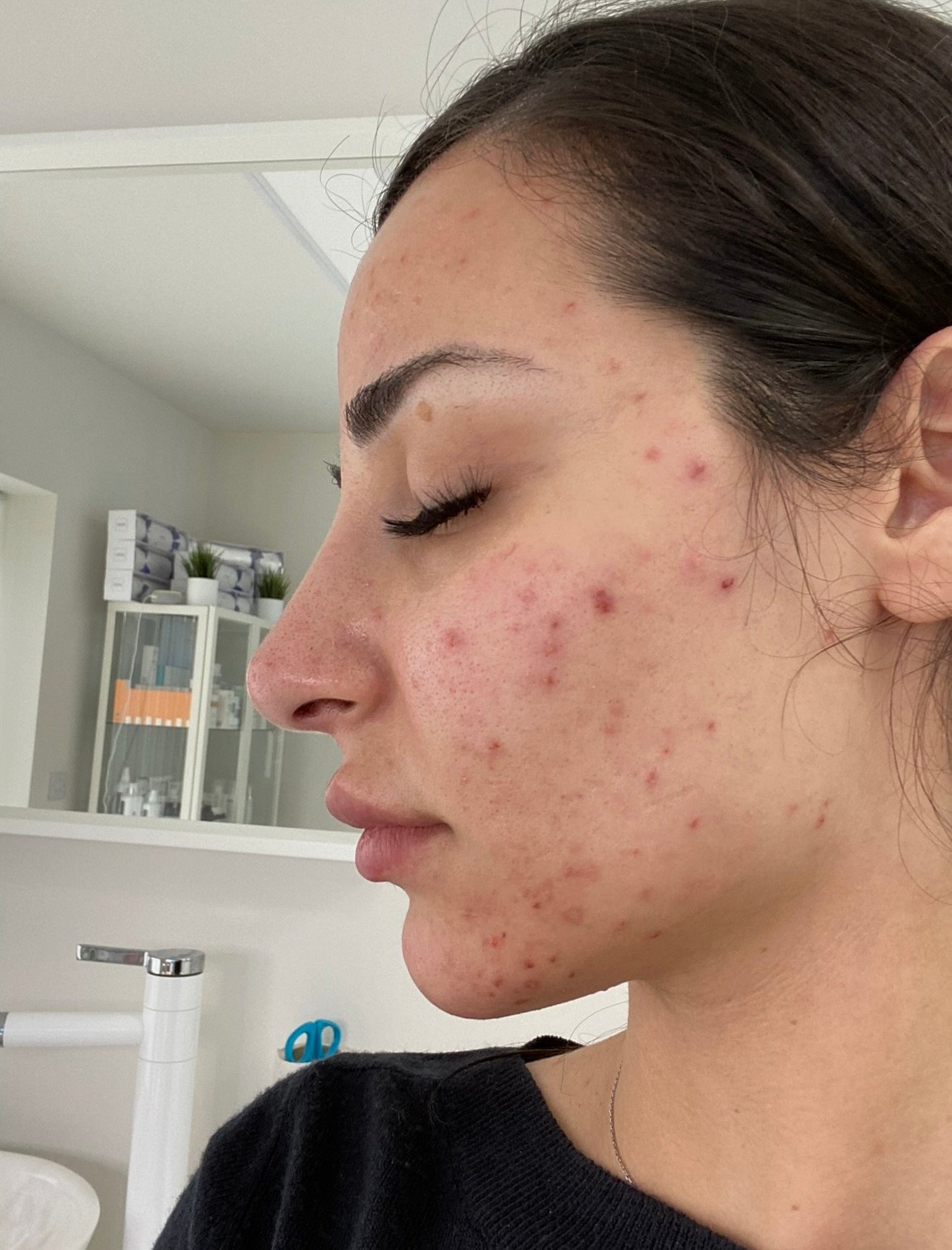 Before pigmentation treatment