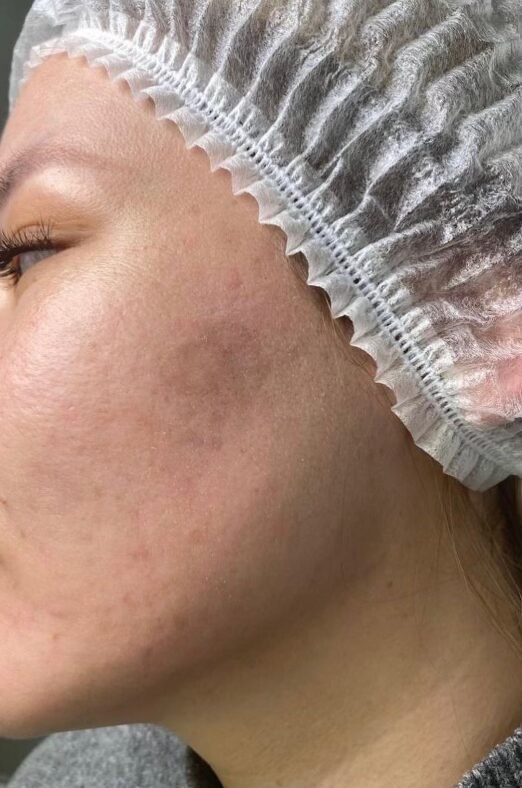 After skin rejuvenation treatment