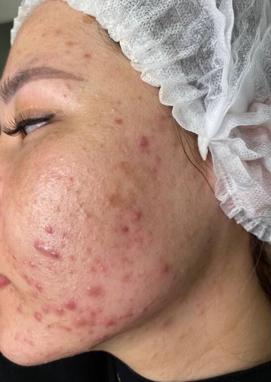 Before skin rejuvenation treatment