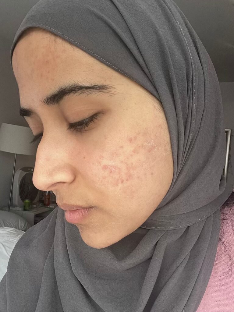 After neck tightening treatment