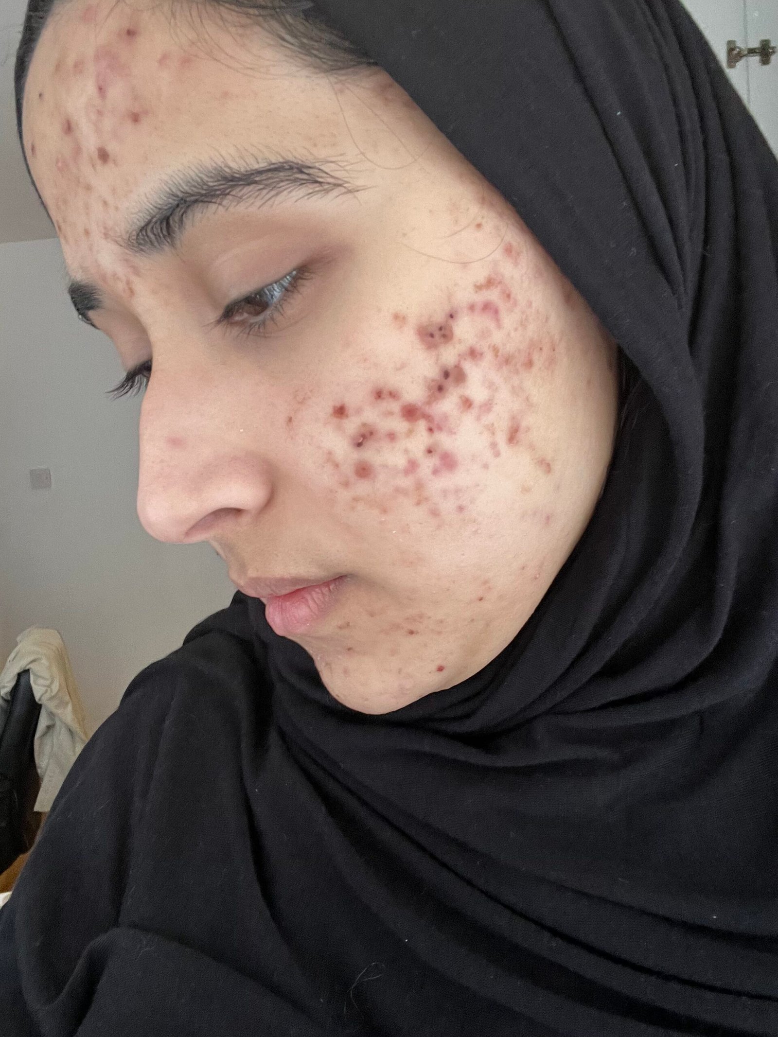 Before neck tightening treatment